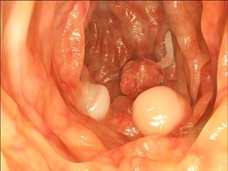Women with metabolically unhealthy phenotypes had higher risks of colorectal cancer than those who were metabolically healthy, even in women who had healthy weights. Women with metabolically unhealthy phenotypes had higher risks of colorectal cancer than those who were metabolically healthy, even in women who had healthy weights.