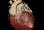 Canagliflozin Reduces Cardiovascular Stress in Older Patients With T2D Canagliflozin Reduces Cardiovascular Stress in Older Patients With T2D
