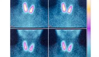 Bipolar disorder affects approximately 2.4% of the population and is associated with high rates of relapse. Bipolar disorder affects approximately 2.4% of the population and is associated with high rates of relapse.