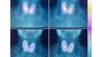 The Diagnostic Work-Up of Thyroid Nodules: Ruling out Papillary Thyroid Cancer The Diagnostic Work-Up of Thyroid Nodules: Ruling out Papillary Thyroid Cancer