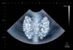 Risk of Pregnancy Loss in Subclinical Hypothyroidism Risk of Pregnancy Loss in Subclinical Hypothyroidism