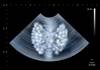 Risk of Thyroid Dysfunction Not Associated With HIV Status Risk of Thyroid Dysfunction Not Associated With HIV Status