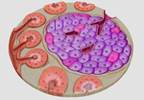 Artificial Pancreas Treatment Efficacious for Type 1 Diabetes Artificial Pancreas Treatment Efficacious for Type 1 Diabetes
