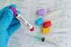 Low HbA1c After Metformin Initiation Lowers CV Risks in T2D Patients Low HbA1c After Metformin Initiation Lowers CV Risks in T2D Patients