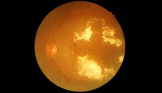 Researchers compared the efficacy of aflibercept, bevacizumab, and ranibizumab. Researchers compared the efficacy of aflibercept, bevacizumab, and ranibizumab.