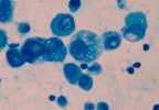Malignancy Risk & Vitamin D Deficiency: An Unclear Relationship Malignancy Risk & Vitamin D Deficiency: An Unclear Relationship