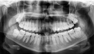 Among patients with varying levels of periodontitis, prediabetes or type 2 diabetes diagnoses were common. Among patients with varying levels of periodontitis, prediabetes or type 2 diabetes diagnoses were common.