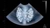 Impaired Vascular Dysfunction in Primary Hyperparathyroidism May Impact Cognition Impaired Vascular Dysfunction in Primary Hyperparathyroidism May Impact Cognition