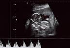 Maternal Overweight, Obesity Linked to Increase in Fetal Birth Defects Maternal Overweight, Obesity Linked to Increase in Fetal Birth Defects