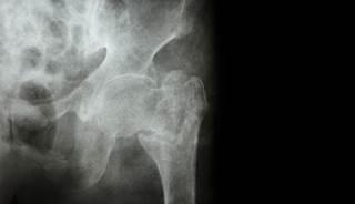 Researchers examined the nonvertebral fracture risk in adults with obesity who underwent Roux-en-Y gastric bypass vs adjustable gastric banding. Researchers examined the nonvertebral fracture risk in adults with obesity who underwent Roux-en-Y gastric bypass vs adjustable gastric banding.
