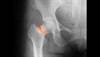 Osteoporosis, Fracture Risk Elevated With Tuberculosis Osteoporosis, Fracture Risk Elevated With Tuberculosis