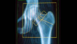 The trabecular bone score may provides an acute, albeit indirect, measurement of bone quality in patients with type 2 diabetes. The trabecular bone score may provides an acute, albeit indirect, measurement of bone quality in patients with type 2 diabetes.