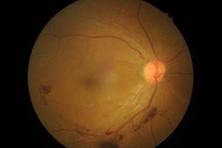 Black and Latino youth were less likely to undergo an eye examination for diabetic retinopathy within 6 years of their diagnosis. Black and Latino youth were less likely to undergo an eye examination for diabetic retinopathy within 6 years of their diagnosis.