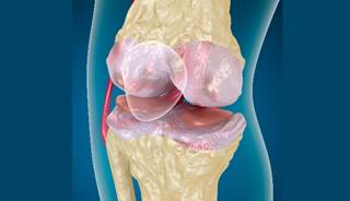 Patients with RA were evaluated at a specialized clinic to determine the relationship between knee osteoarthritis and elevated Disease Activity Scores (DAS28). Patients with RA were evaluated at a specialized clinic to determine the relationship between knee osteoarthritis and elevated Disease Activity Scores (DAS28).