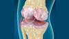 Does Osteoarthritis Diagnosis Affect Rheumatoid Arthritis Disease Activity Scores? Does Osteoarthritis Diagnosis Affect Rheumatoid Arthritis Disease Activity Scores?