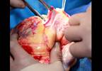 Empagliflozin Use Supported in Patients With DM Post-Cardiac Transplantation Empagliflozin Use Supported in Patients With DM Post-Cardiac Transplantation