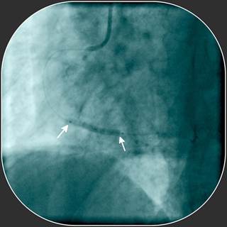 Compared with uninterrupted DAPT, disruption was associated with increased risk of MACE, regardless of the diabetic status. Compared with uninterrupted DAPT, disruption was associated with increased risk of MACE, regardless of the diabetic status.