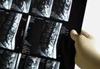 Do Bone Turnover Markers Predict Vertebral Fracture Risk Post-Alendronate Discontinuation? Do Bone Turnover Markers Predict Vertebral Fracture Risk Post-Alendronate Discontinuation?