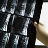 Is DXA Required to Diagnose Vertebral Fracture in Patients With Low BMD? Is DXA Required to Diagnose Vertebral Fracture in Patients With Low BMD?