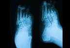 Antibiotic Resistant Bacteria Common in Diabetic Foot Ulcers Antibiotic Resistant Bacteria Common in Diabetic Foot Ulcers