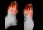 Nerve Decompression Potentially Beneficial in Painful Diabetic Neuropathy Nerve Decompression Potentially Beneficial in Painful Diabetic Neuropathy
