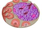 Elevated Pancreatic Polypeptide May Predict Coronary Artery Disease in T2DM Elevated Pancreatic Polypeptide May Predict Coronary Artery Disease in T2DM