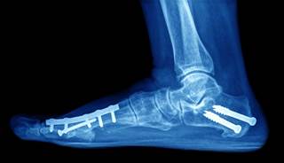 Kaplan-Meier analysis showed that the median time to the first fracture in patients was 2.88 years and 7.32 years for the third fracture. Kaplan-Meier analysis showed that the median time to the first fracture in patients was 2.88 years and 7.32 years for the third fracture.