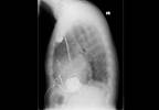 Higher Thyroid-Stimulating Hormone Levels Associated With Worse Heart Failure Higher Thyroid-Stimulating Hormone Levels Associated With Worse Heart Failure