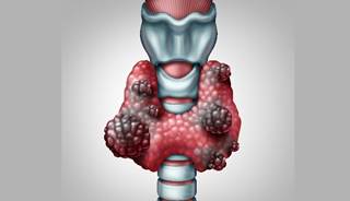 Increases in papillary thyroid cancer were most common between 1974 and 2013. Increases in papillary thyroid cancer were most common between 1974 and 2013.