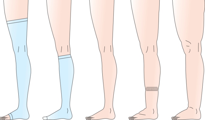 Can Compression Socks Be Safely Used in Diabetics With Lower Extremity ...