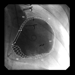 Hip or femoral neck bone mineral density in women was not associated with heart failure risk. Hip or femoral neck bone mineral density in women was not associated with heart failure risk.