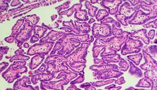 Irregular users of thyroxine were less likely to develop thyroid cancer compared to regular users. Irregular users of thyroxine were less likely to develop thyroid cancer compared to regular users.