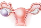 Reducing Ectopic Fat Restores Normalized Ovulation in PCOS Reducing Ectopic Fat Restores Normalized Ovulation in PCOS