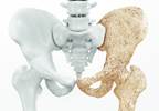Risks Associated With Denosumab Discontinuation Risks Associated With Denosumab Discontinuation