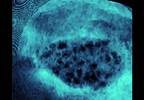 Metformin May Improve Pregnancy Outcomes in Polycystic Ovary Syndrome Metformin May Improve Pregnancy Outcomes in Polycystic Ovary Syndrome