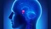 Testosterone Replacement Therapy May Protect Against Stroke, Heart Attack in Hypogonadism Testosterone Replacement Therapy May Protect Against Stroke, Heart Attack in Hypogonadism
