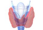 Silent Thyroiditis Risk Increased With Lithium Therapy for Bipolar Disorder Silent Thyroiditis Risk Increased With Lithium Therapy for Bipolar Disorder