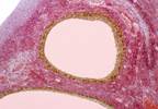 Polycystic Ovary Syndrome Tied to Risk for Mental Health Issues Polycystic Ovary Syndrome Tied to Risk for Mental Health Issues