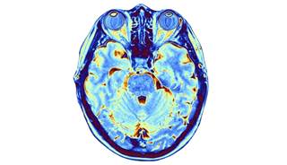 In addition to brain imaging, patients underwent cognitive tests to assess memory, executive function, and psychomotor speed. In addition to brain imaging, patients underwent cognitive tests to assess memory, executive function, and psychomotor speed.