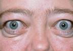 Active Ophthalmopathy Benefits From Teprotumumab Treatment Active Ophthalmopathy Benefits From Teprotumumab Treatment