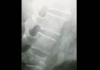 Fracture Risk Decreases, Bone Mineral Density Increases With Long-Term Denosumab Fracture Risk Decreases, Bone Mineral Density Increases With Long-Term Denosumab