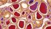 Parathyroidectomy for Secondary, Tertiary Hyperparathyroidism Increases Morbidity and Mortality Parathyroidectomy for Secondary, Tertiary Hyperparathyroidism Increases Morbidity and Mortality