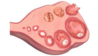Early menarche and early menopause increased cardiovascular disease risk. Early menarche and early menopause increased cardiovascular disease risk.