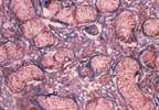 Testosterone Therapy Prescribing Practices in VA Setting Testosterone Therapy Prescribing Practices in VA Setting