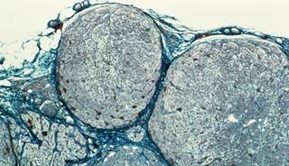 Medication is the most common cause of Cushing's syndrome. <i>Image credit: CNRI/Science Source</i> Medication is the most common cause of Cushing's syndrome. <i>Image credit: CNRI/Science Source</i>
