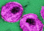 BMD Loss Slowed With Delayed Antiretroviral Therapy in HIV BMD Loss Slowed With Delayed Antiretroviral Therapy in HIV