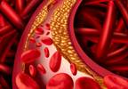Thyroid Dysfunction Not a Risk Factor for Carotid Plaque Development Thyroid Dysfunction Not a Risk Factor for Carotid Plaque Development