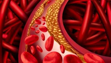 Thyroid Dysfunction Not a Risk Factor for Carotid Plaque Development Thyroid Dysfunction Not a Risk Factor for Carotid Plaque Development