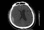 Radioiodine Therapy and Hemorrhagic Stoke: Are Risk Levels Increased? Radioiodine Therapy and Hemorrhagic Stoke: Are Risk Levels Increased?
