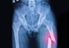 New Bone Density Assessment Effectively Predicts Fracture Risk in Children New Bone Density Assessment Effectively Predicts Fracture Risk in Children